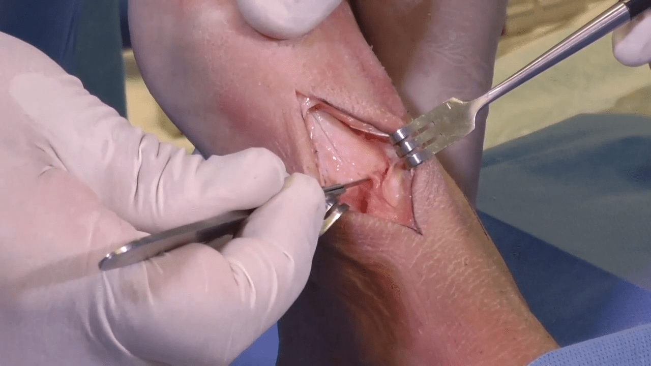 An image from the "Lisfranc Arthrodesis: Using Autogenous Bone Graft & the Trephine Technique with Alan Ng, DPM, FACFAS" video on the JnJInstitute.com website.