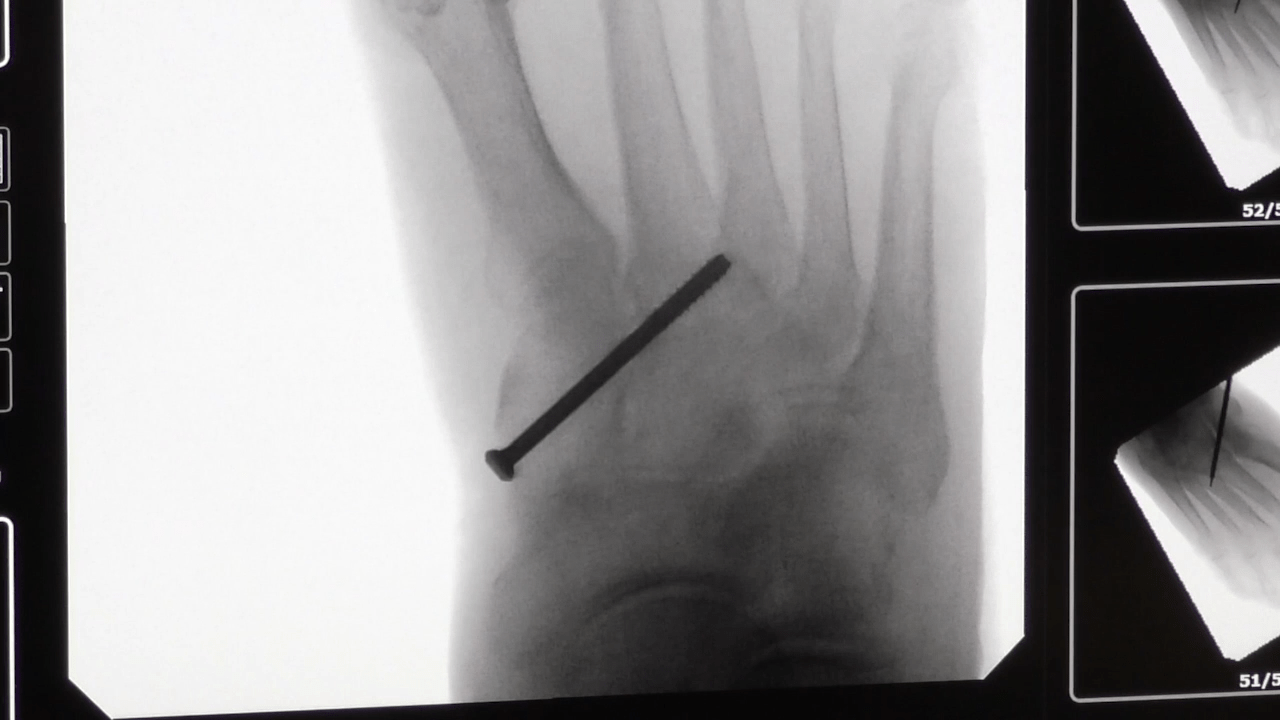 An image of the "Percutaneous Stabilization of a Fracture Dislocation with Alan Ng, DPM, FACFAS" video on the JnJInstitute.com website.