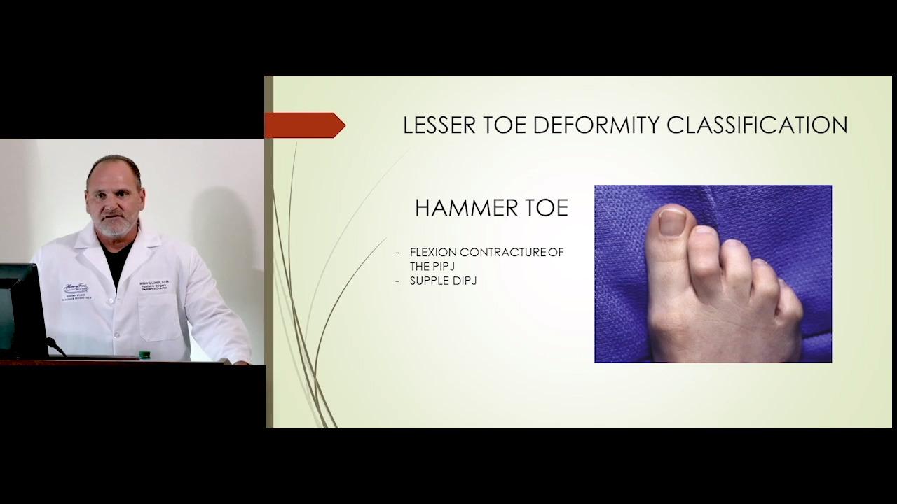 An image from the "Surgery of the Lesser Toe Deformity with Brian G. Loder, DPM" playlist om the JnJInstitute.com website.
