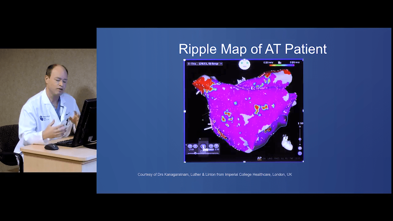 An image from the "Ripple Mapping in Atrial Tachycardia with Daniel Melby, MD" video on the JnJInstitute.com website.