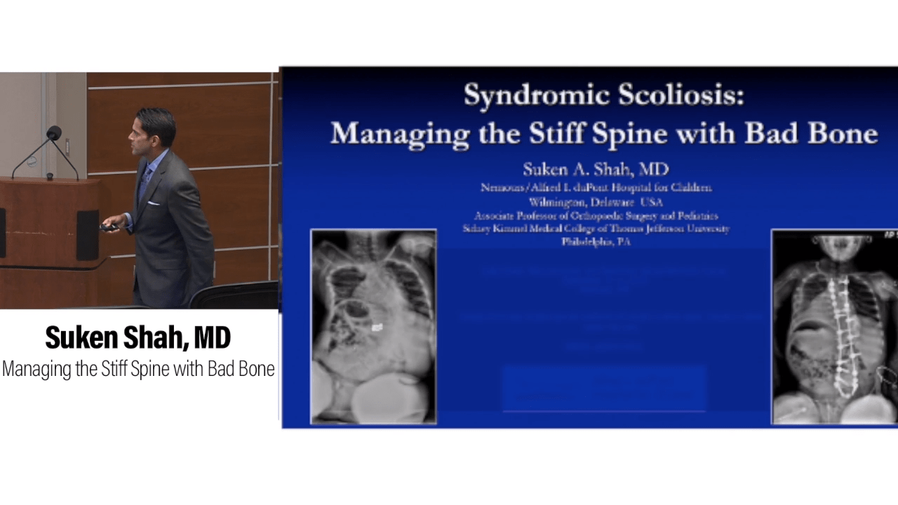 An image from the "Managing the Stiff Spine with Bad Bone with Suken Shah, MD" video on the JnJInstitute.com website.