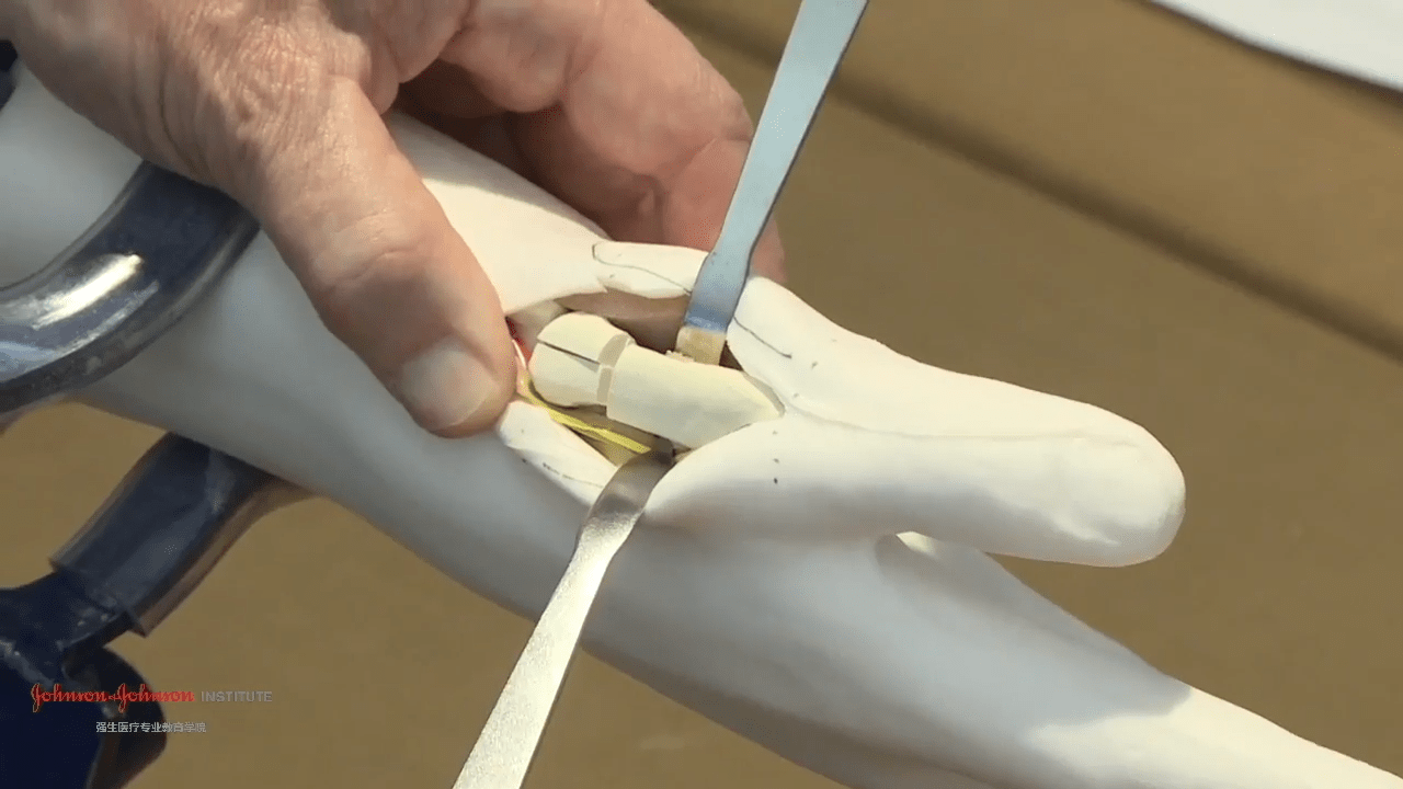An image from the "Variable Angle Locking Plate for Thumb Fractures with Douglas Campbell, MD" video on the JnJInstitute.com website.
