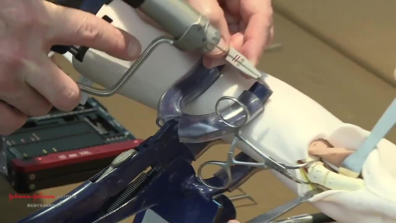 An image from the "Variable Angle Locking Plate for Thumb Fractures - The Palmer Approach with Douglas Campbell, MD" video on the JnJInstitute.com website.