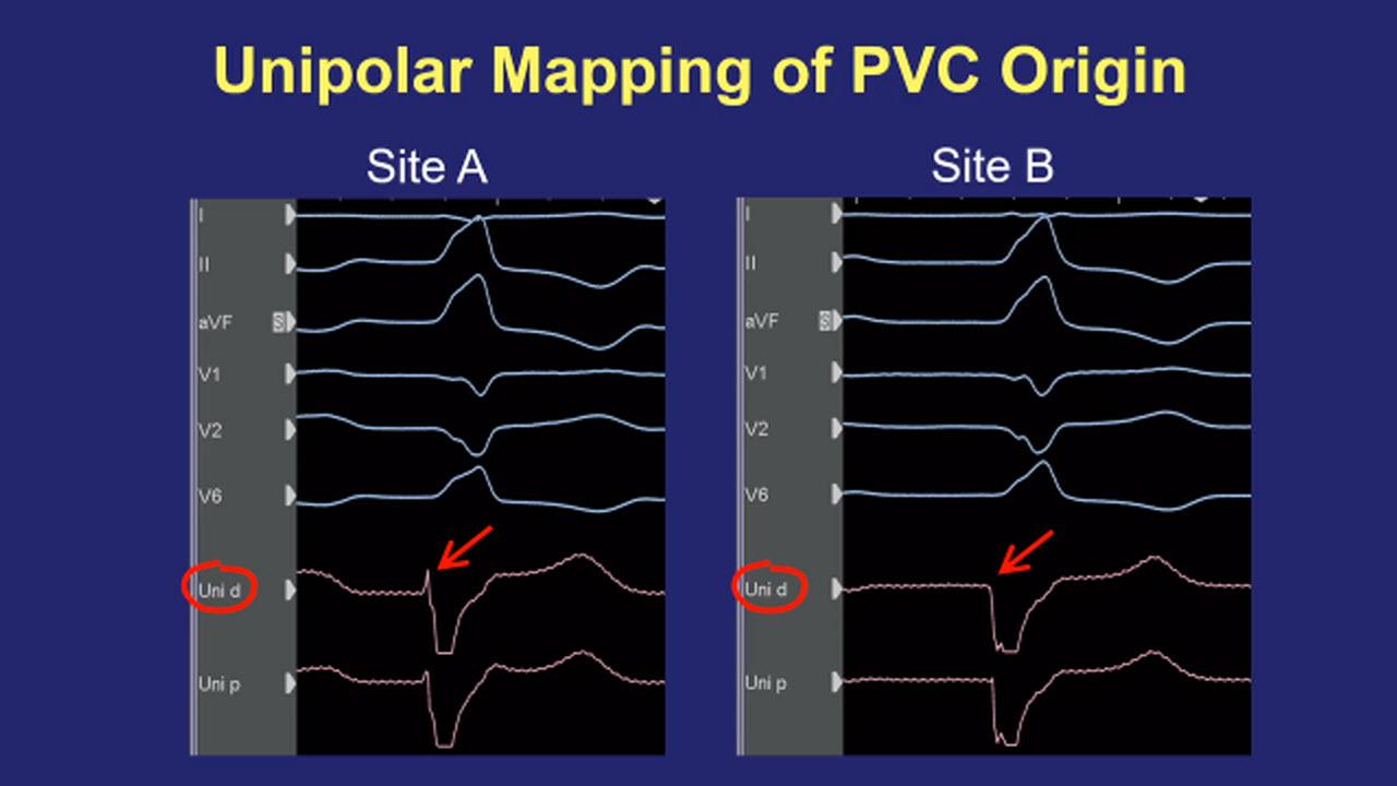 An image from the "Introduction to Intracardiac Electrograms with Joshua Cooper, MD" video playlist on the JnJInstitute.com website.