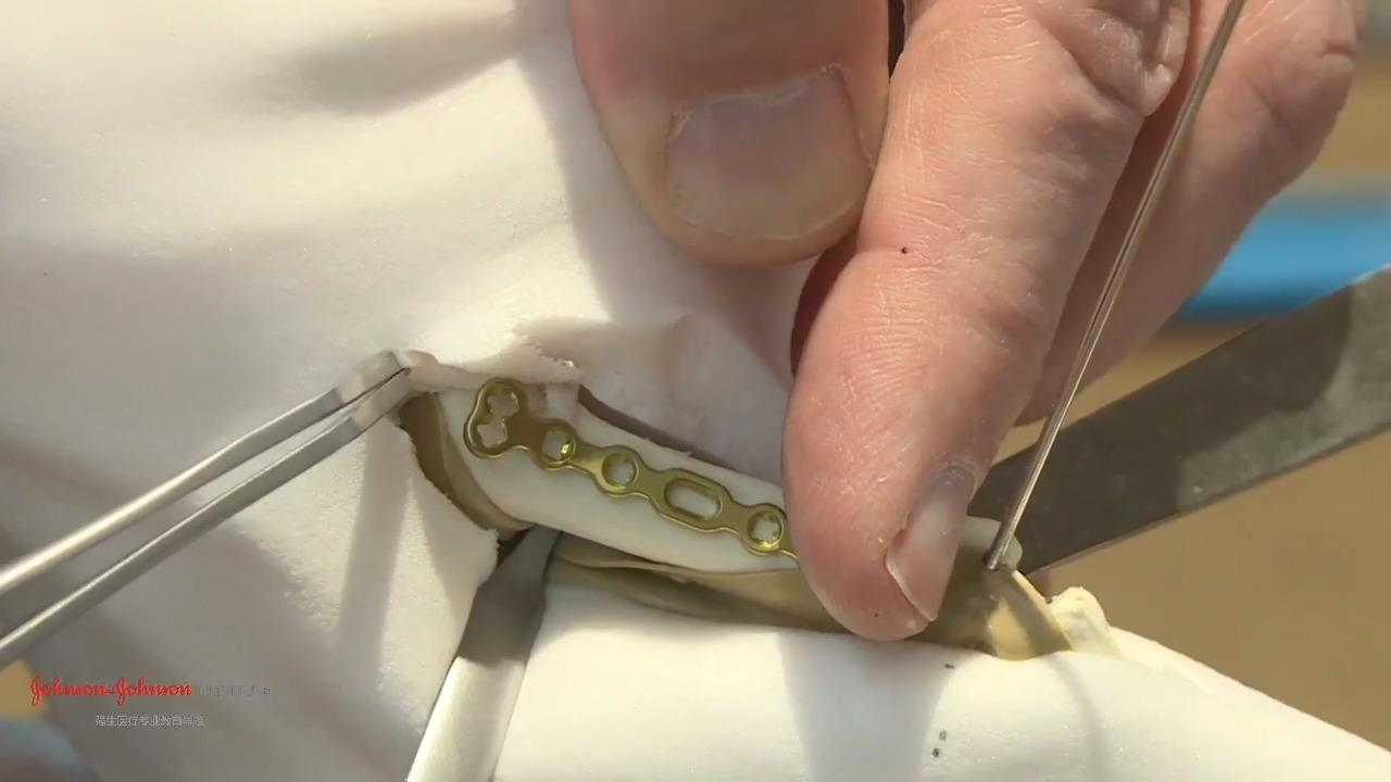 An image from the "Phalangeal Base Plate - Lateral or Dorsal Placement with Douglas Campbell, MD" video on the JnJInstiute.com website.