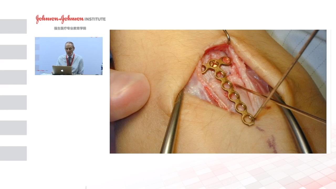 An image from the "Rotational Malunion with Douglas Campbell, MD" video on the JnJInstitute.com website.
