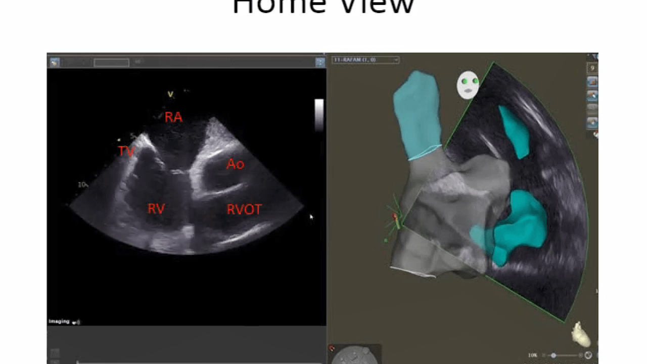 A view of Intracardiac Echo imaging for transseptal puncture and atrial anatomy.