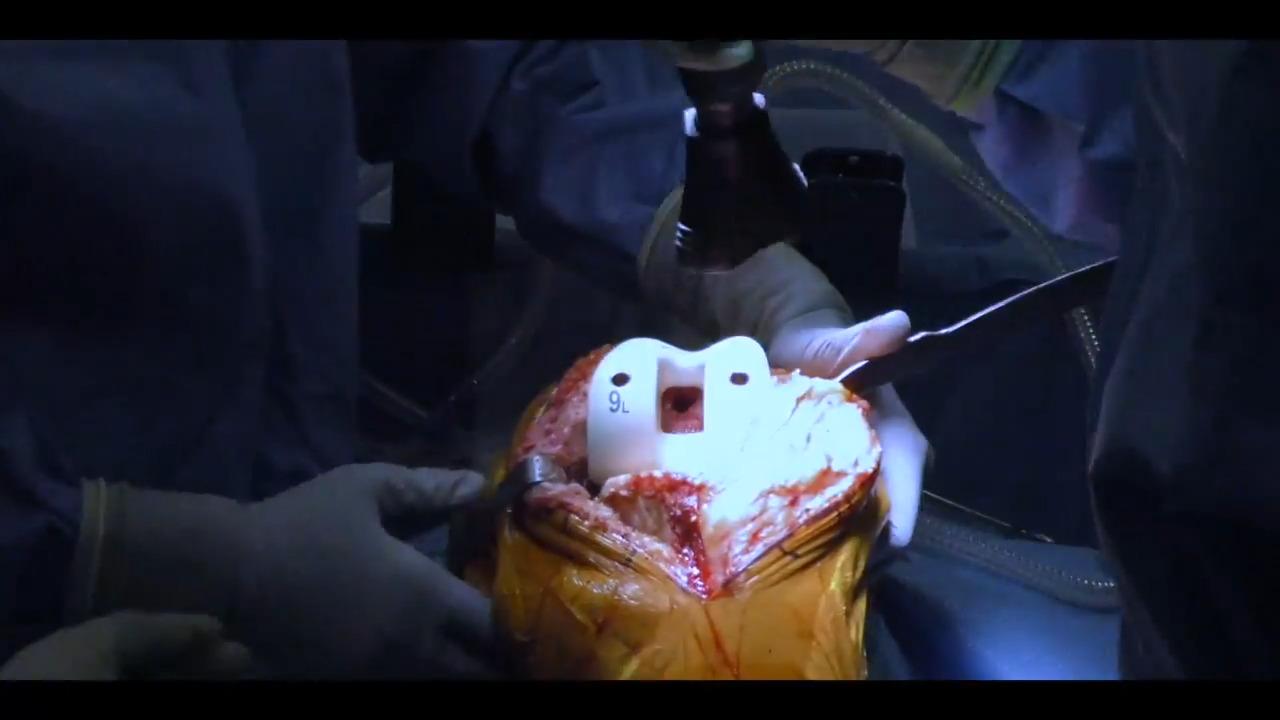 An image from the "Total Knee Arthroplasty using the ATTUNE® Knee System: Sizing Guide & Implant Trialing with William Barrett, MD & Jana Flener, PA-C" video on the JnJInstitute.com website.