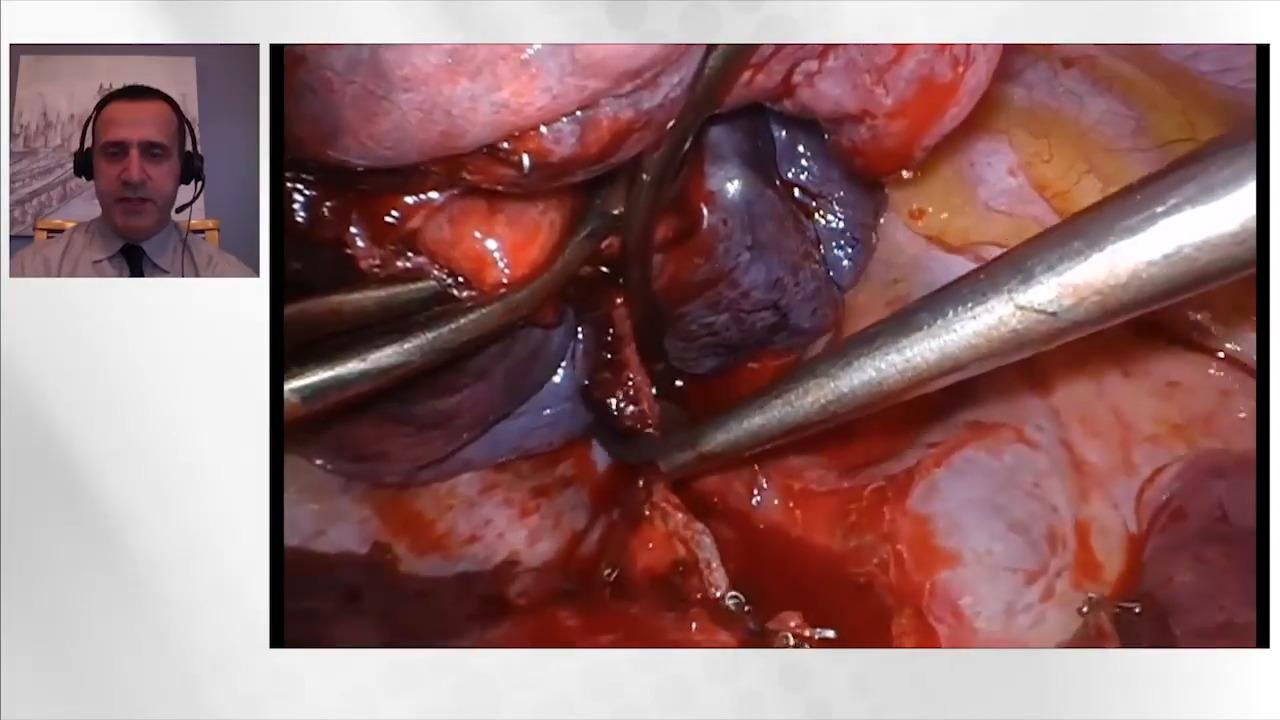 An image from the "Thoracic Surgery Techniques & Approaches using Ultrasonic Energy with Zane Hammoud, MD" video on the JnJInstitute.com website.