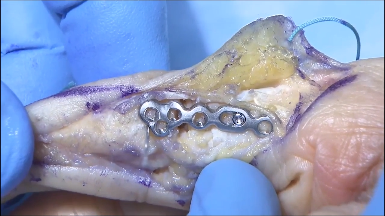 An image of the "VA Locking Hand System - Phalangeal Head Plate with Thomas Fischer, MD" video.