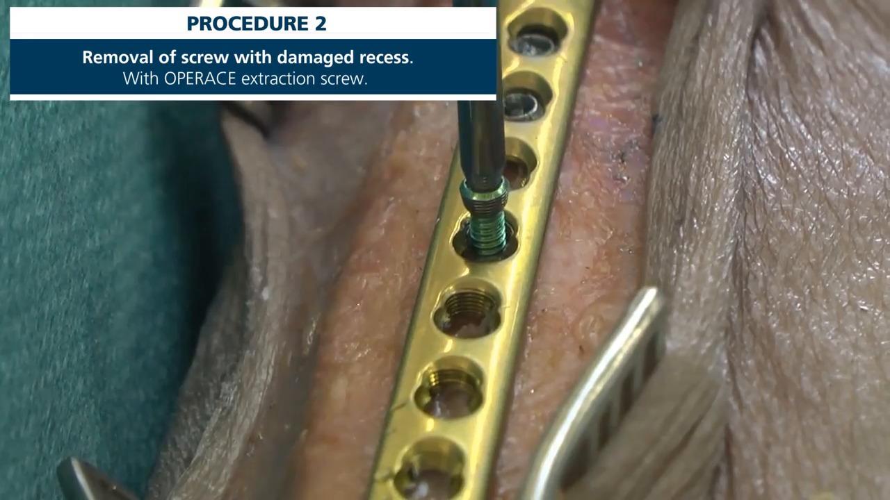 An image from the "Osteosynthesis Implant Removal with OPERACE®" video on the JnJInstitute.com website.