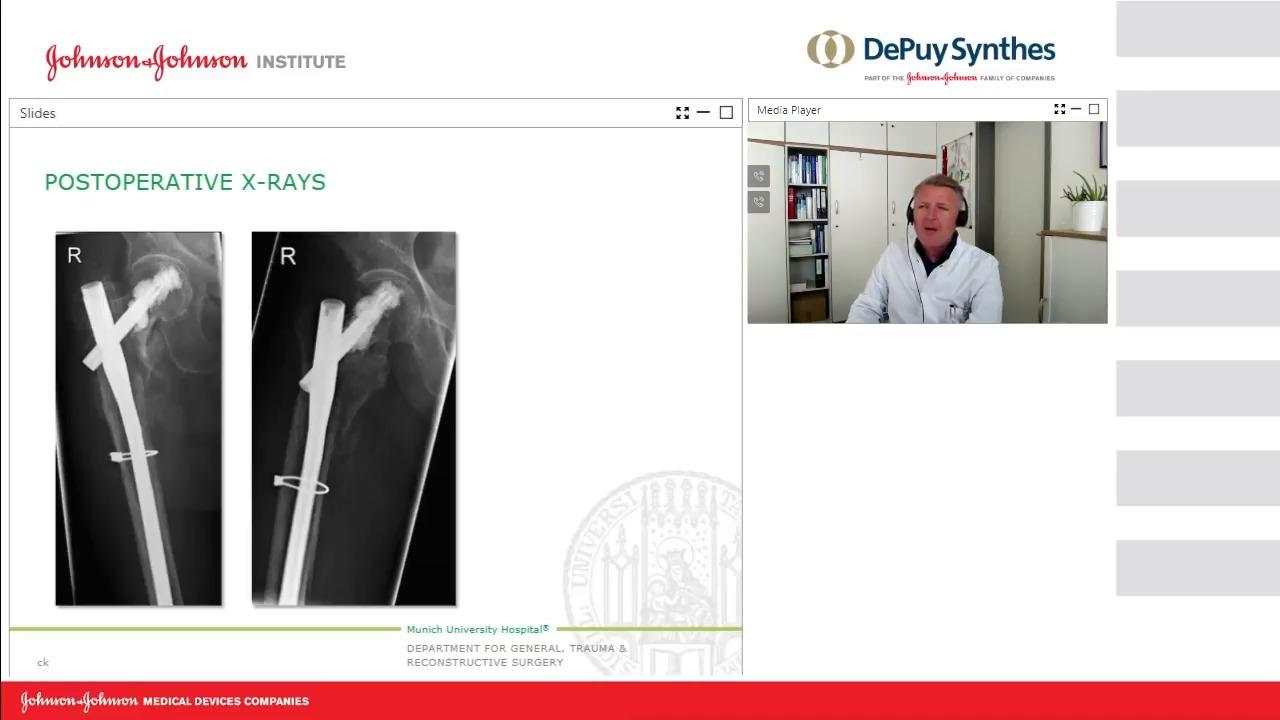 An image from the "Hip Fracture Continuum of Care" video on the JnJInstitute.com website.