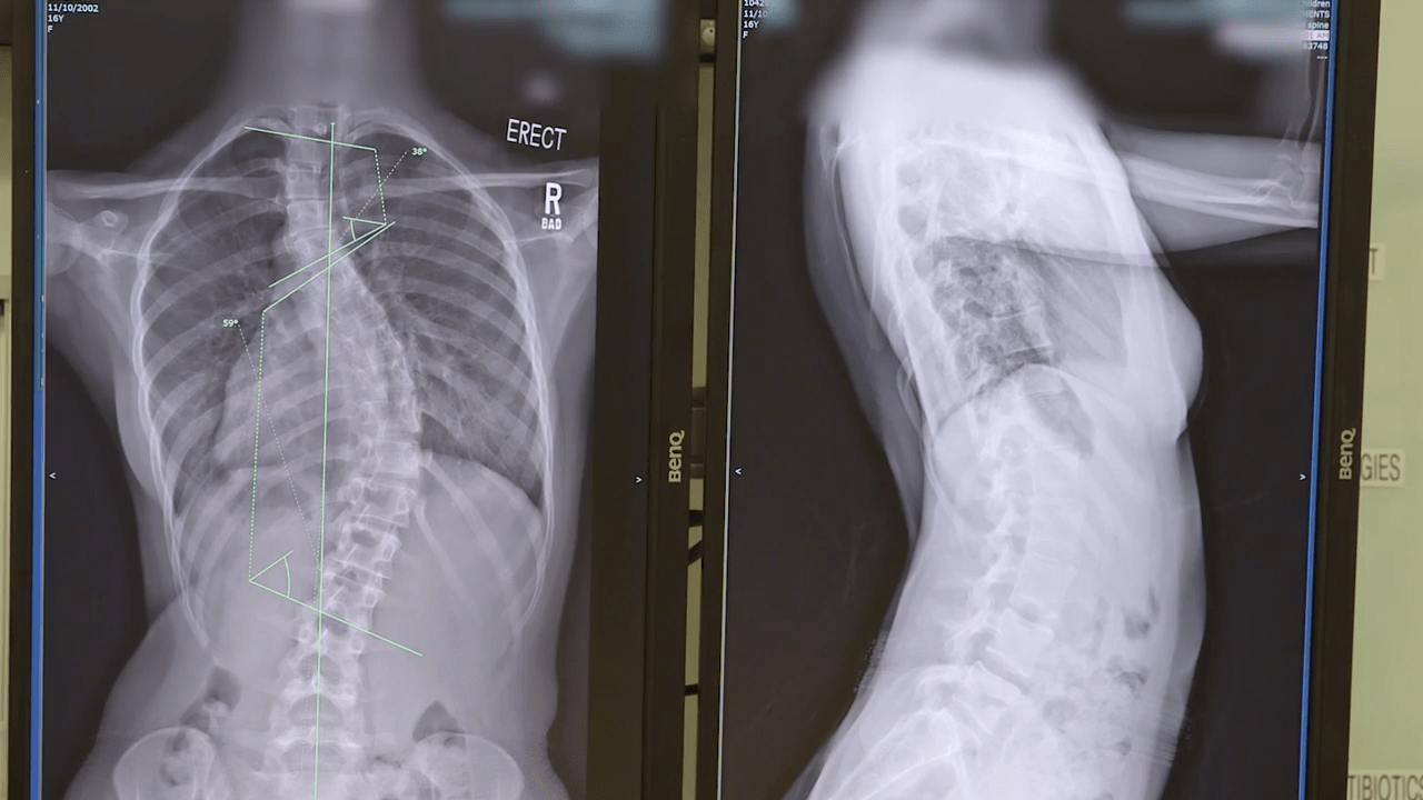 An image from the "Posterior Correction of Adolescent Idiopathic Scoliosis with Attention to Differential Rod Contouring with Suken A. Shah, MD" video on the JnJInstitute.com website.
