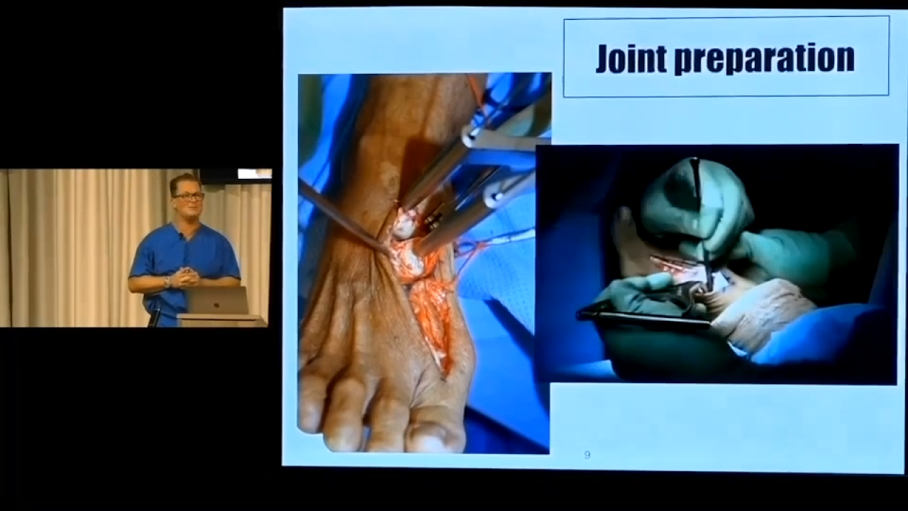 An image from the "Management of Midfoot Arthritis & Lis Franc Injuries" playlist on the JnJInstitute.com website.