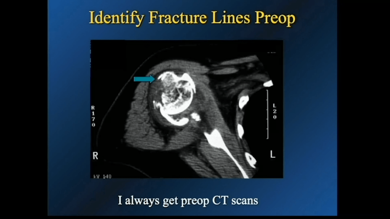 An image from the "Proximal Humerus Fractures: Treatment with Hemi-Arthroplasty with Carl Basamania, MD" video on the JnJInstitute.com website.