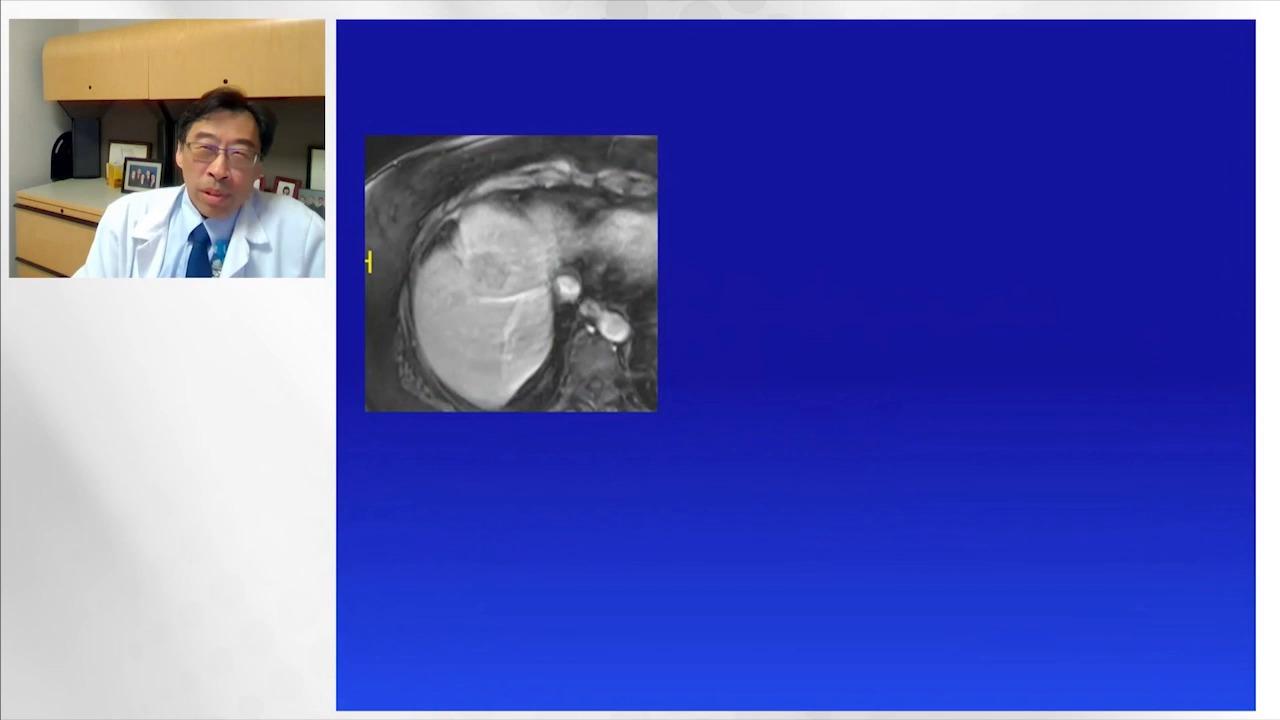 An image from the "NeuWave™ Microwave Ablation: The Clinical Value of Ablation Confirmation with David Lu, MD" video on the JnJInstitute.com website.
