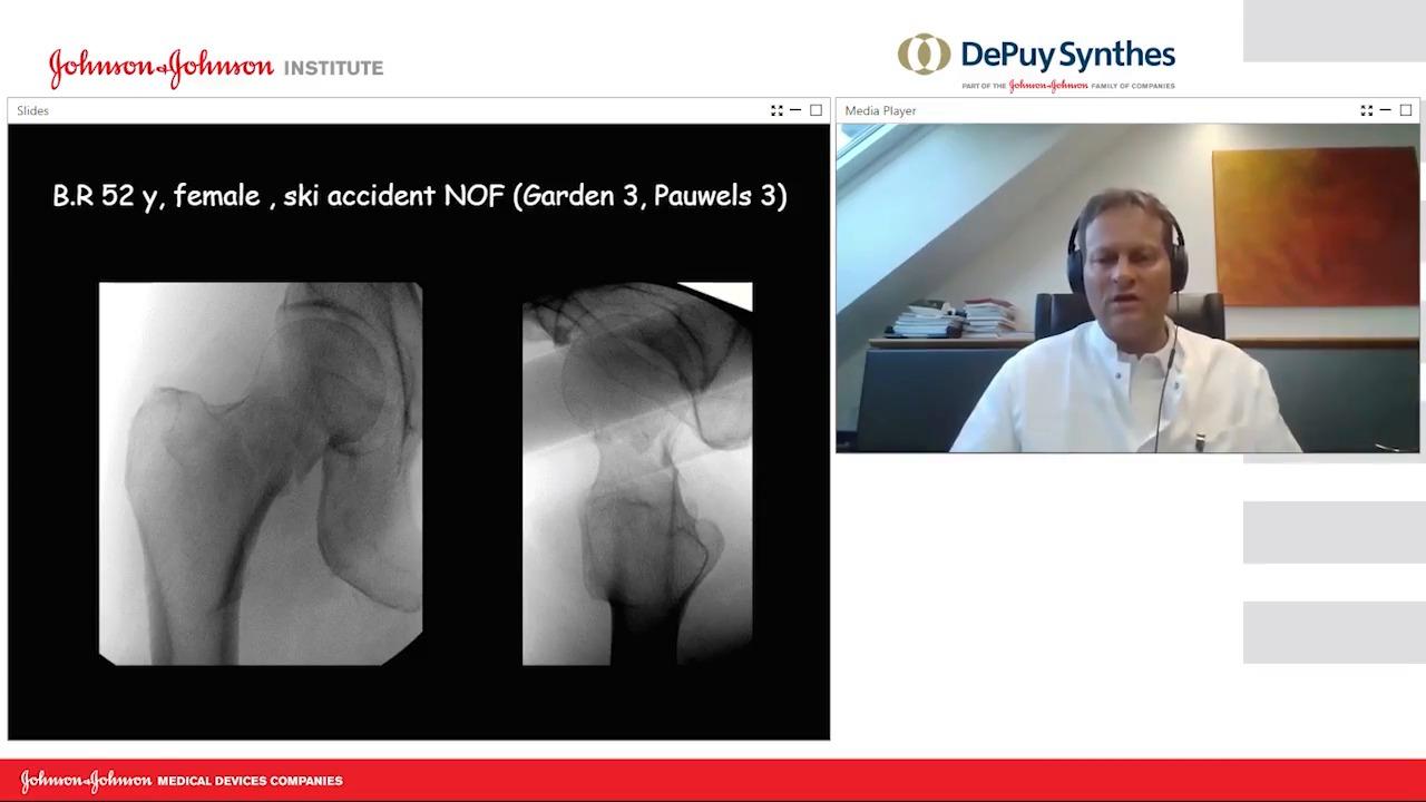 An image from the "Management of Femoral Neck Fractures with FNS with Karl Stoffel, MD" video on the JnJInstitute.com website.