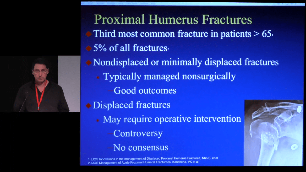 An image from the "Reverse Total Shoulder Arthroplasty in Proximal Humerus Fractures with Paul Favorito, MD" video on the JnJInstitute.com website.