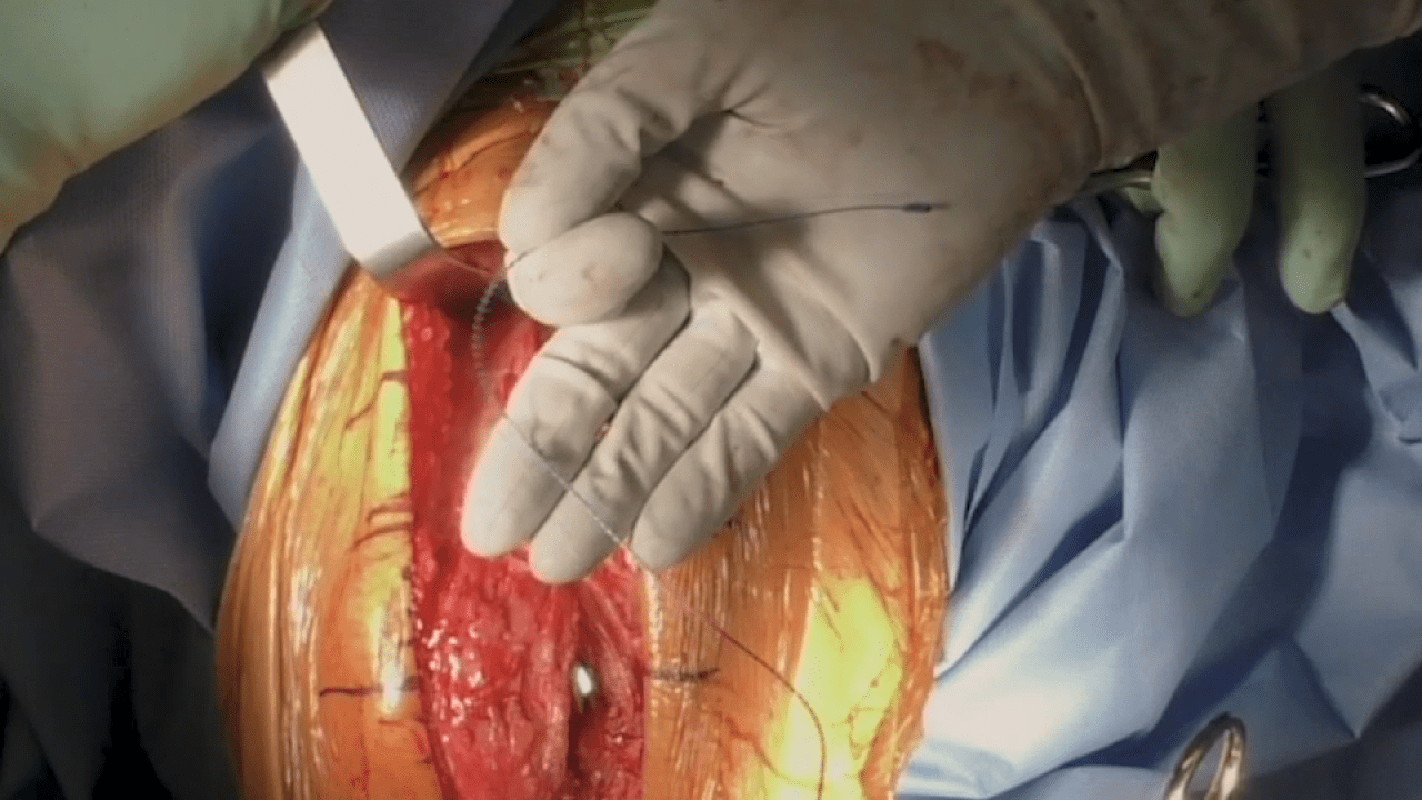 An image from the "Total Knee Arthroplasty Wound Closure with William Barrett, MD" video on the JnJInstitute.com website.