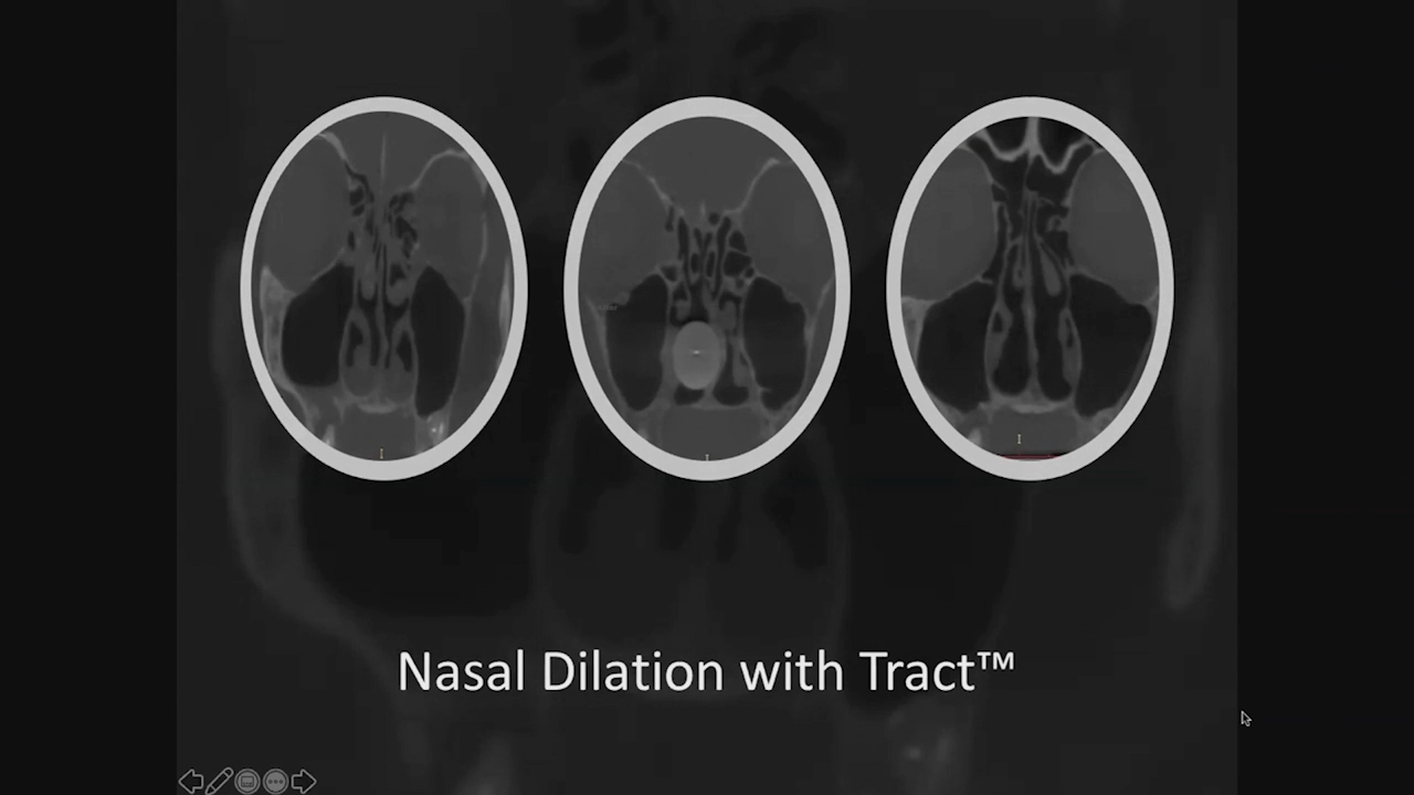 An image from the "My Journey: RELIEVA Tract™ Nasal Dilation System with Karen Hoffmann, MD" video on the JnJInstitute.com website.