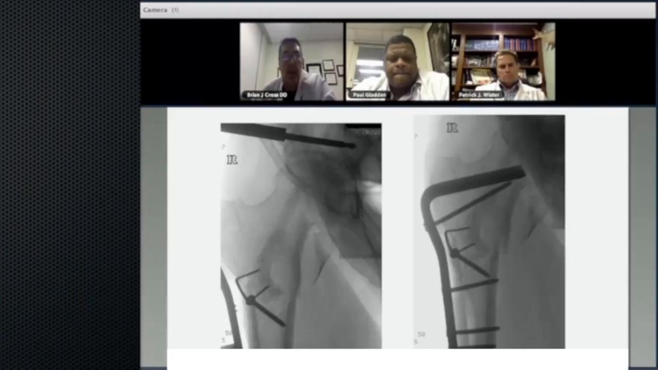 An image from the "The Utility of Continuous Compression Implants for Trauma Applications: Pertrochanteric Fractures Case Presentation with Brian Cross, DO; Paul Gladden, MD; Patrick Wiater, MD" video on the JnJInstitue.com website.