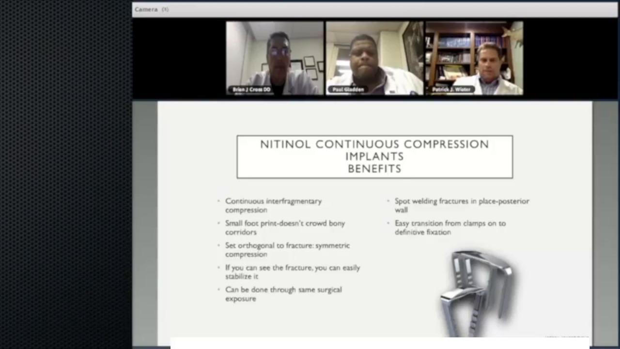 An image from the "The Utility of Continuous Compression Implants for Trauma Application: Clinical Benefits with Brian Cross, DO; Paul Gladden, MD; Patrick Wiater, MD" video on the JnJInstitute.com website.