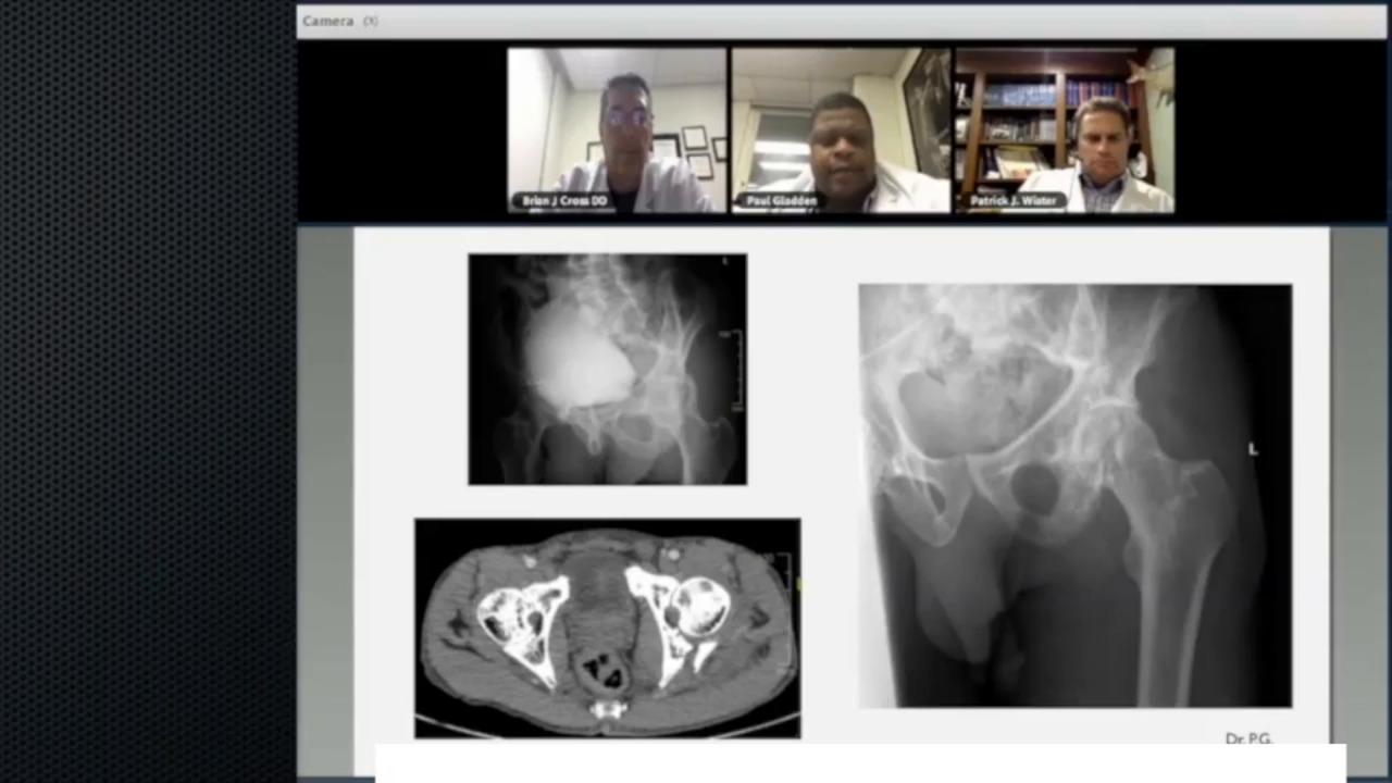 An image from the "The Utility of Continuous Compression Implants for Trauma Application: Posterior Column Fractures Case Presentation with Brian Cross, DO; Paul Gladden, MD; Patrick Wiater, MD" video on the JnJInstitute.com website.