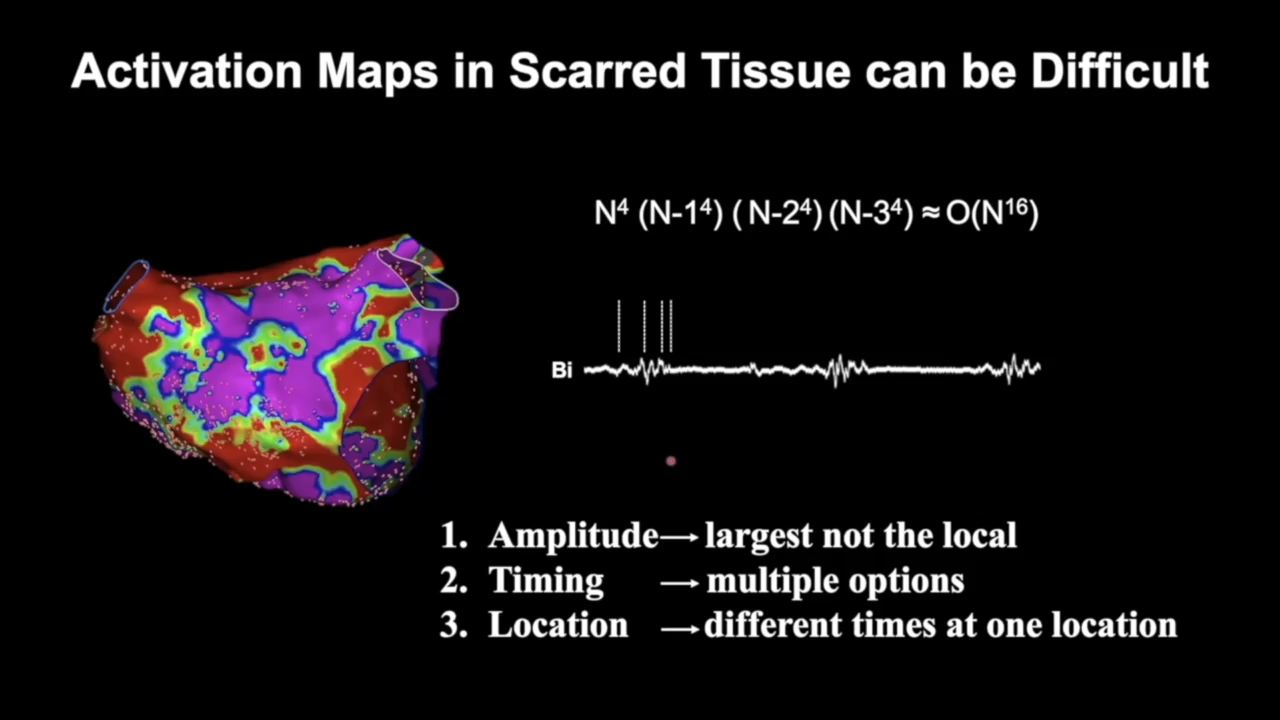 An image from the "Advanced Techniques for Mapping Complex Arrhythmias with Elad Anter, MD" video on the JnJInstitute.com website.