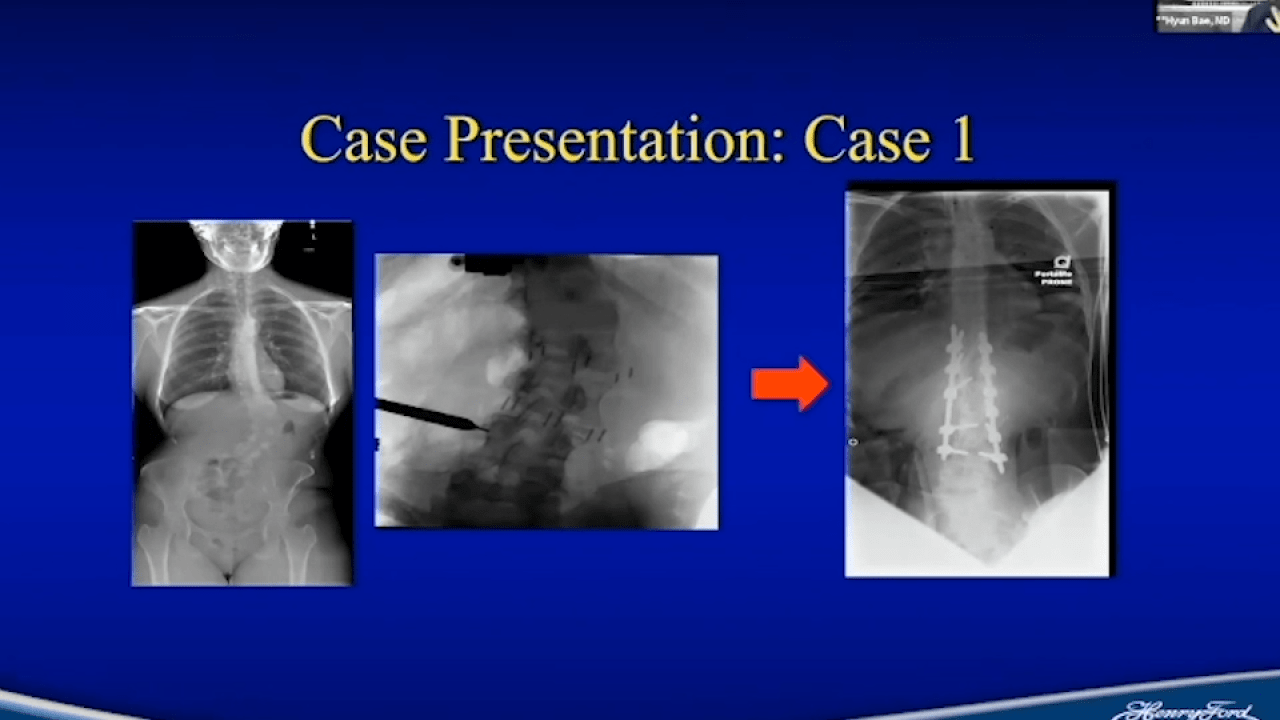 An image from the "The Role of Biomaterials in the Lumbar Spine Surgery with Hyun Bae, MD & Frank LaMarca, MD" video on the JnJInstitute.com website.