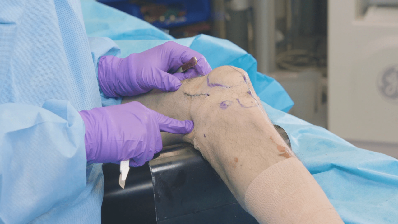 An image from the "RFN-Advanced Retrograde Femoral Nailing System (RFNA): Locking Attachment Washer, Parapatellar Approach with Matthew Graves, MD" video on the JnJInstitute.com website.