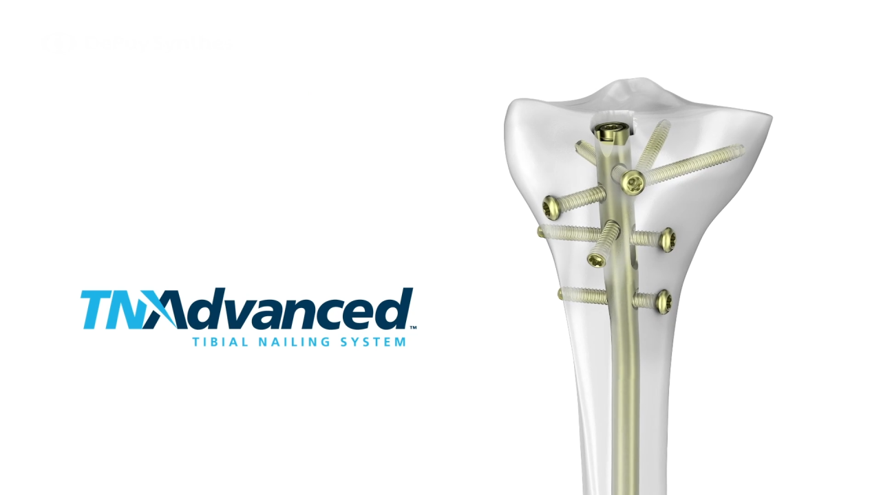 An image from the "TFN-ADVANCED Tibial Nailing System: Distal Locking with Matthew Graves, MD" video on the JnJInstitute.com website.
