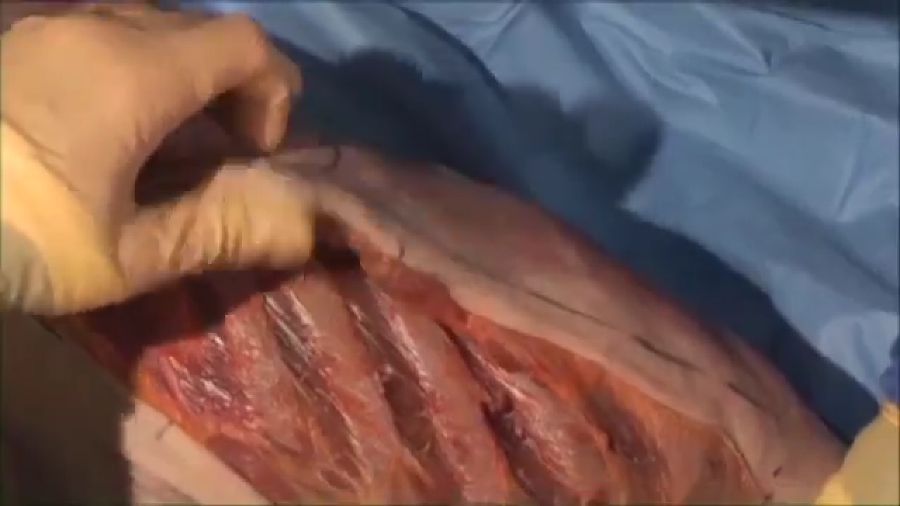 An image from the "Muscle Sparing Approach to Anterolateral Rib Fractures with Steve Madey, MD & Bill Long, MD" video on the JnJInstitute.com website.