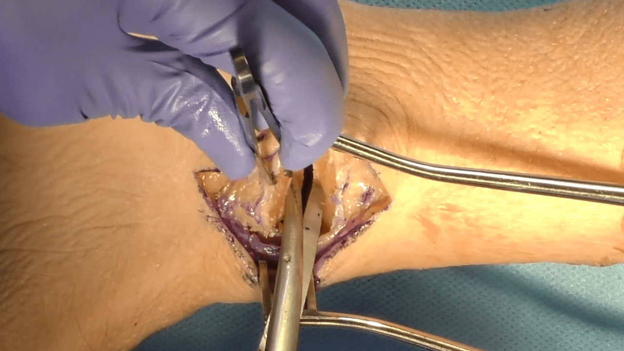 An image from the "Medial Malleolus Fracture Reduction Techniques with Megan Paulus, MD"