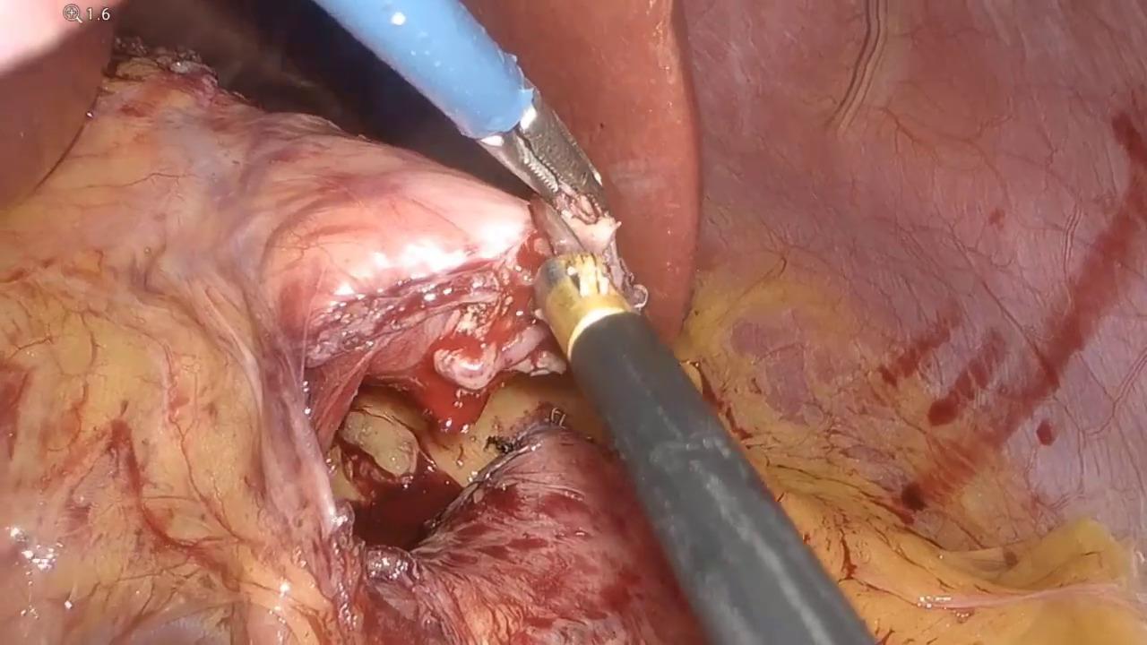 An Image from "Weight regain after Sleeve Gastrectomy"