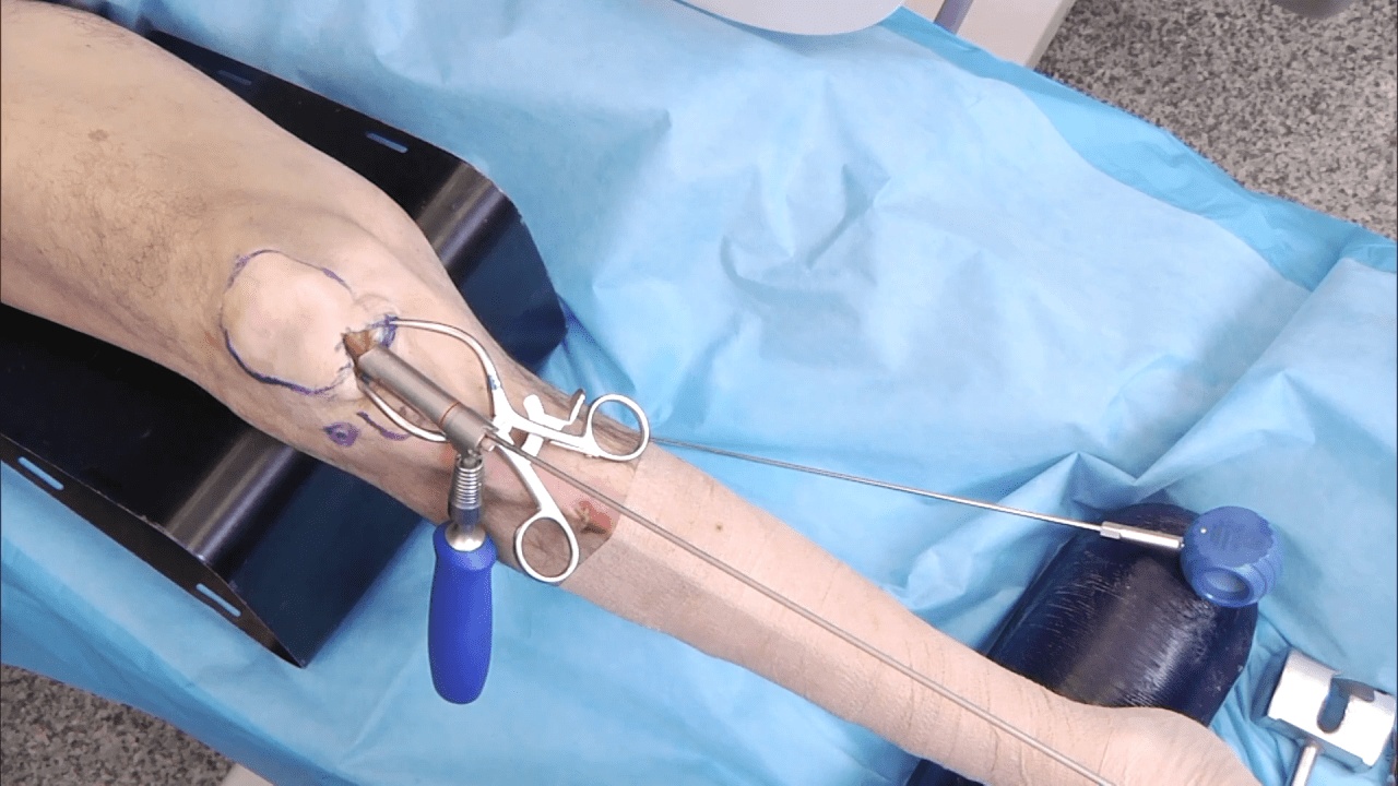 An image from the "RFN-Advanced Retrograde Femoral Nailing System (RFNA): Nail Insertion" video on the JnJInstitute.com website.