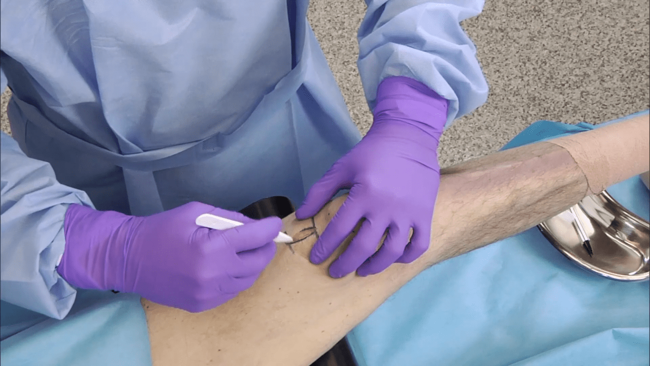 An image from the "TFN-ADVANCED Tibial Nailing System: Suprapatellar Approach - Entry Point with Matthew Graves, MD" video on the JnJInstitute.com website.