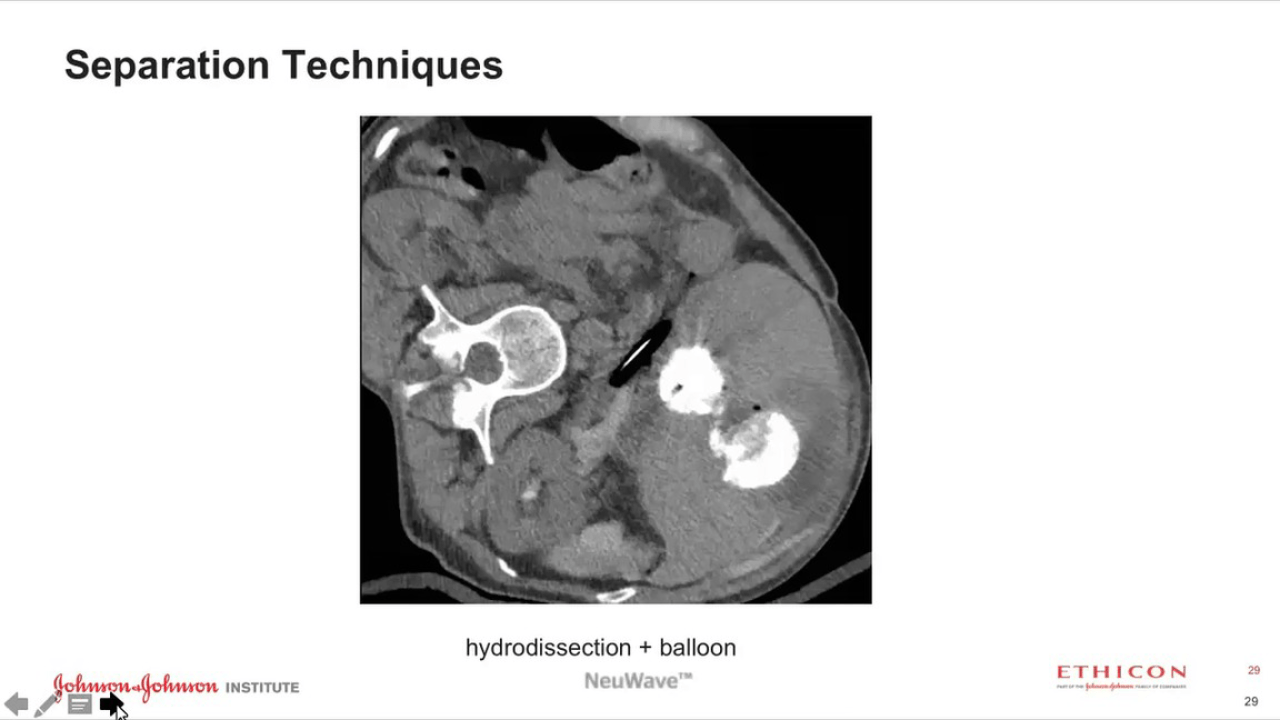 An image from the "Microwave Ablation of Liver and Kidney with Khashayar Farsad, MD" video on JnJInstitute.com