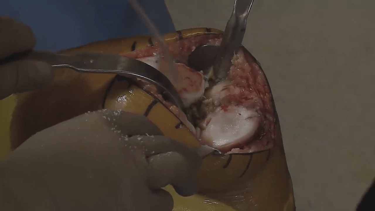 An image from the "ATTUNE Knee System Surgical Insights: Tibial Resection with Peter James, MD & Robert Gorab, MD" video on the JnJInstitute.com website.