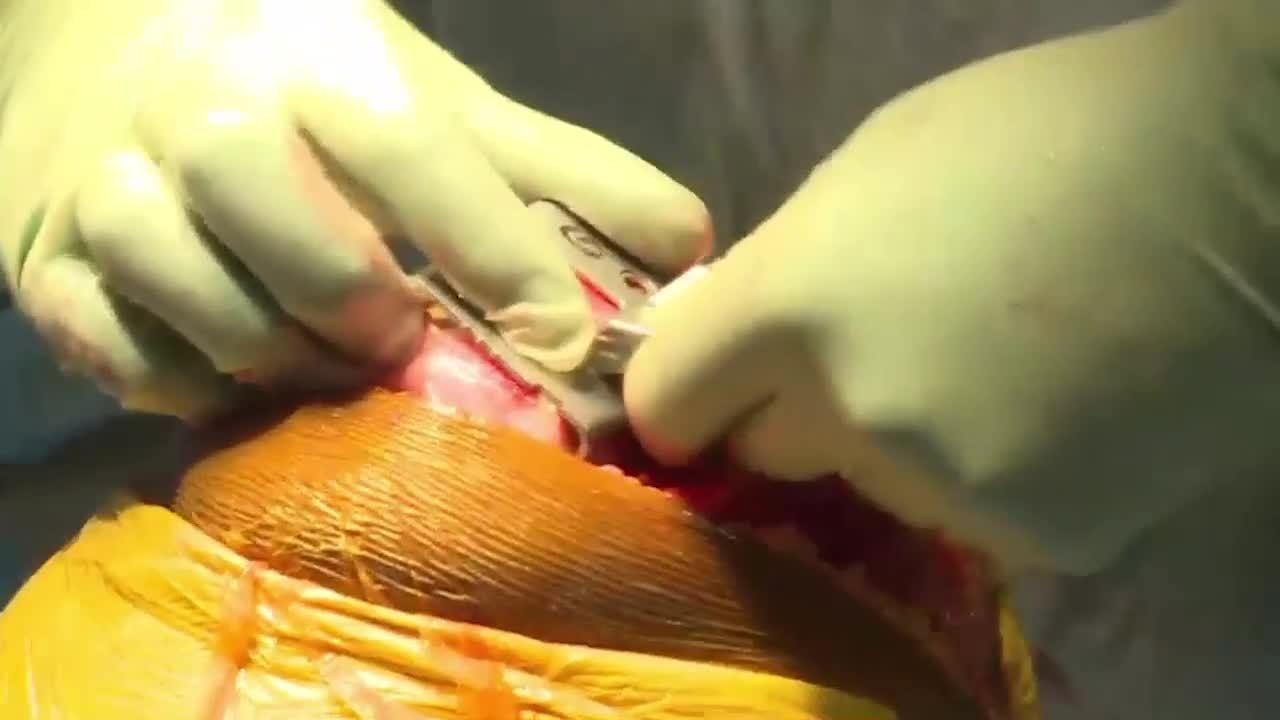 An image from the "ATTUNE RP: Making the Femoral Cuts with Peter James, MD" video on the JnJInstitute.com website.