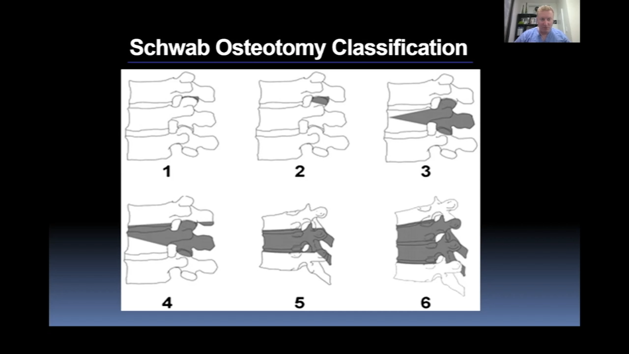 An image from the "Osteotomies: Posterior Column Releases with Stu Hershman, MD" video on the JnJInstitute.com website.