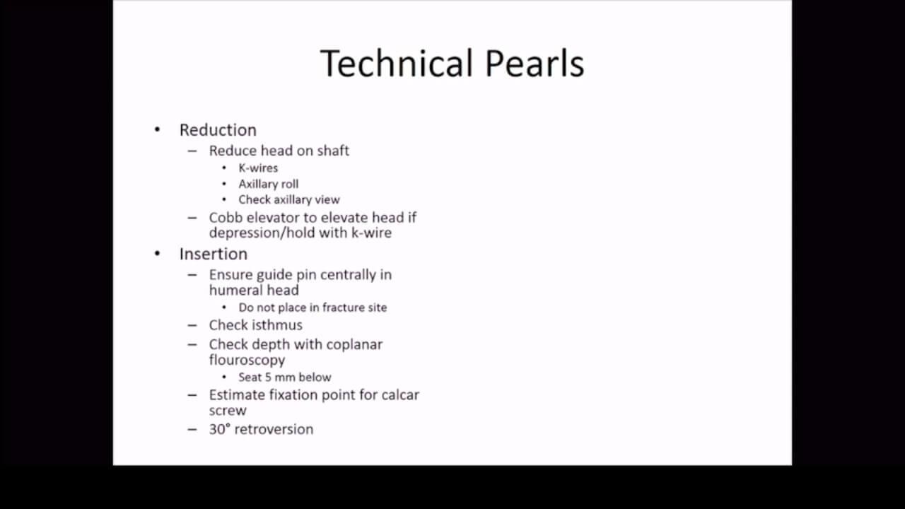 Thumbnail image of Proximal Humerus Fractures: Technical Pearls for MultiLoc Humeral Nails with Brian Vickaryous, MD