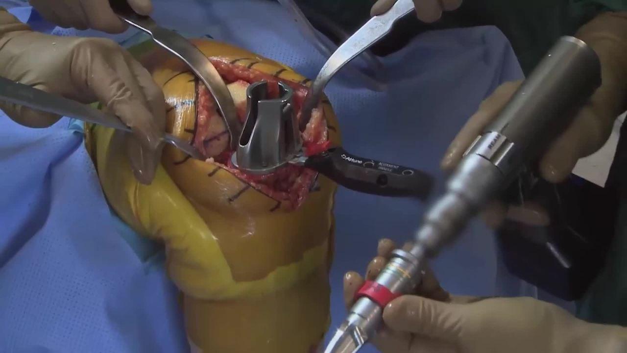 An image from the "Fermoral Preparation with Robert Gorab, MD" video on the JnJInstitute.com website.