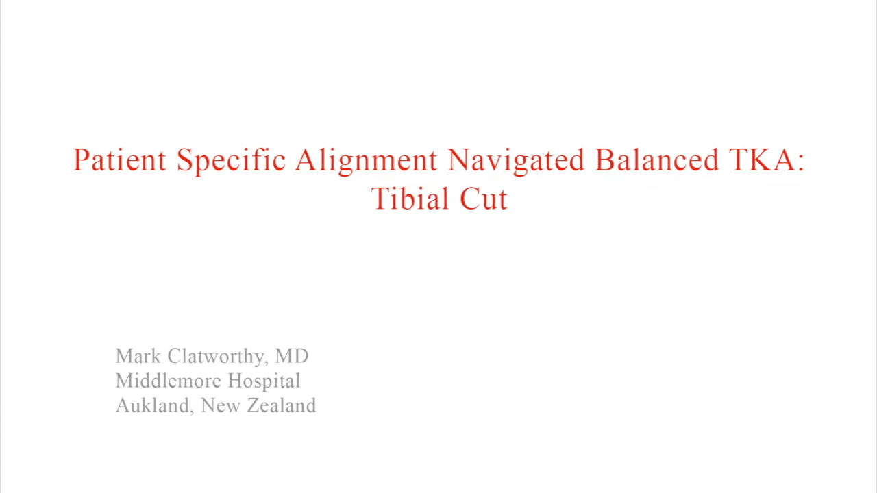 An image from the "Patient Specific Alignment: Tibia First Navigated Balance TKA Approach - Tibial Cut" video on the JnJInstitute.com website.