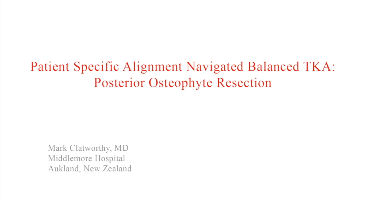 An image from the "Patient Specific Alignment: Tibia First Navigated Balanced TKA Approach - Posterior Osteophyte Resection" video on the JnJInstitute.com website.