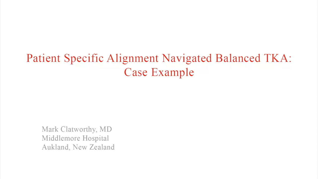 An image from the "Patient Specific Alignment: Tibia First Navigated Balanced TKA Approach - Case Example " video on the JnJInstitute.com website.