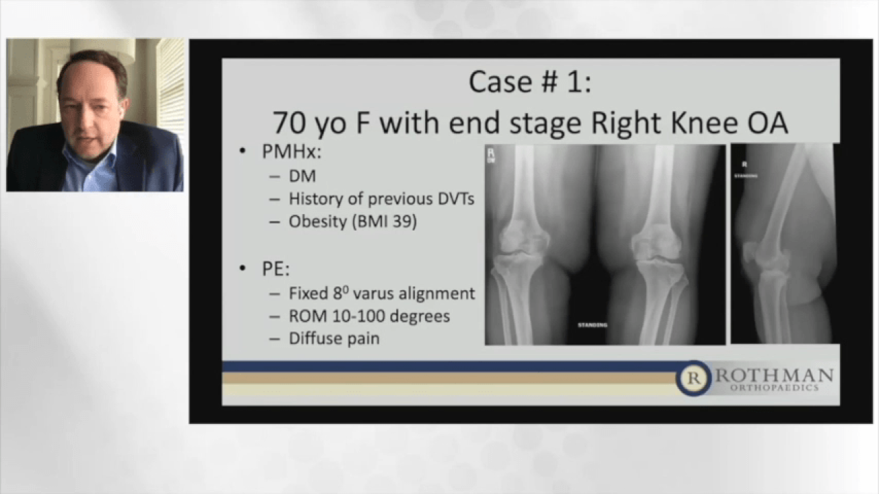 An image from the "Current Techniques & Fixation in Total Knee Arthroplasty: Case Examples" video on the JnJInstitute.com website.
