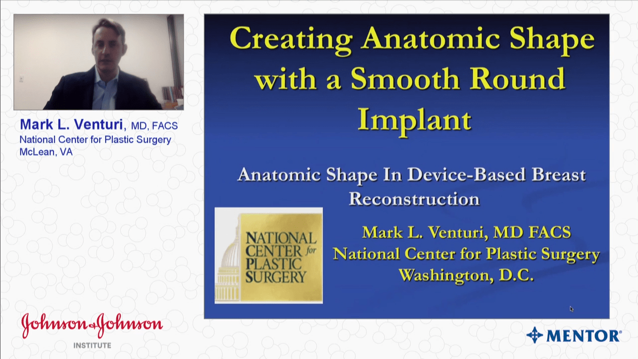 An image from the "Creating Anatomic Shape with Smooth Round Implants with Mark Venturi, MD" video on the JnJInstitute.com website.