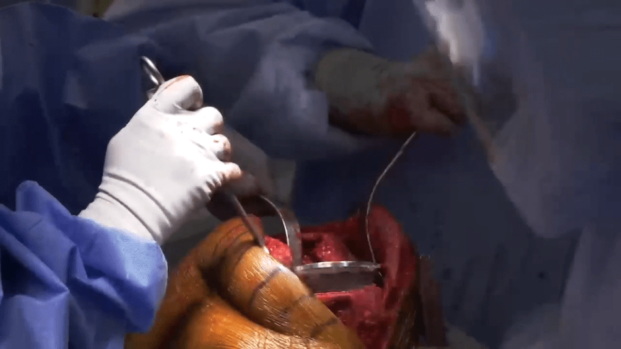 An image from the "ATTUNE Revision: Tibial Preparation with Ryan Nunley, MD" video on the JnJInstitute.com website.
