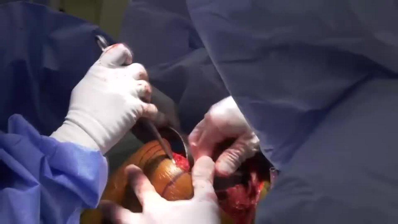 image of Surgical Techniques featuring ATTUNE® Revision Knee System & the KINCISE™ Automated Impactor: Tibial Component Implantation with Ryan Nunley, MD video on jnjinstitute.com