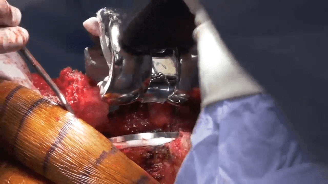 image of Surgical Techniques featuring ATTUNE® Revision Knee System & the KINCISE™ Automated Impactor: Femoral Component Implantation with Ryan Nunley, MD video on jnjinstitute.com